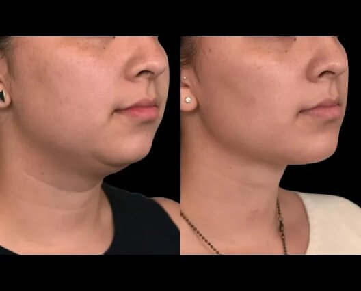 Double chin removal in Dubai: Addressing Stubborn Fat Pockets