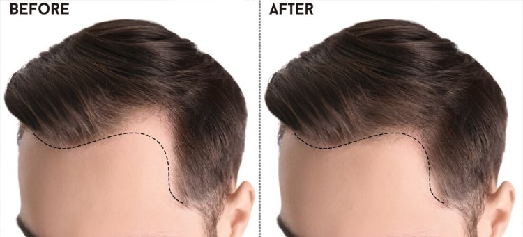 Unlocking the Secrets of Hair Transplant in Islamabad: A Comprehensive Guide to Restoration"