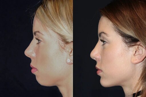 Why the Best Plastic Surgeons in dubai Are Experts in Chin Fillers