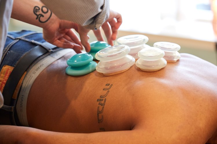 The Healing Power of Cupping Therapy in Philadelphia