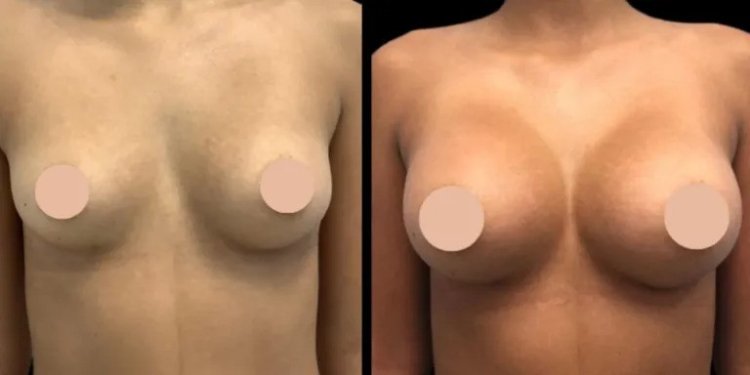 Breast Augmentation and Recovery: What to Expect in Dubai