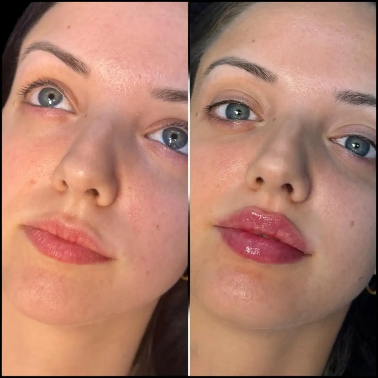 Can Fillers in Dubai Help with Wrinkles and Lines?