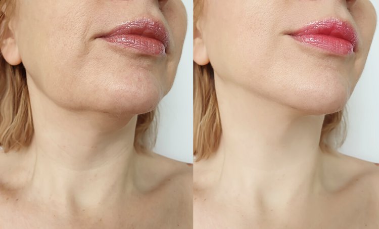 Chin Liposuction in Chicago: Expert Surgeons for a Defined Jawline