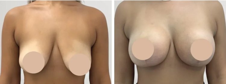 Breast Lift Surgery in dubai: How to Prepare for the Best Results