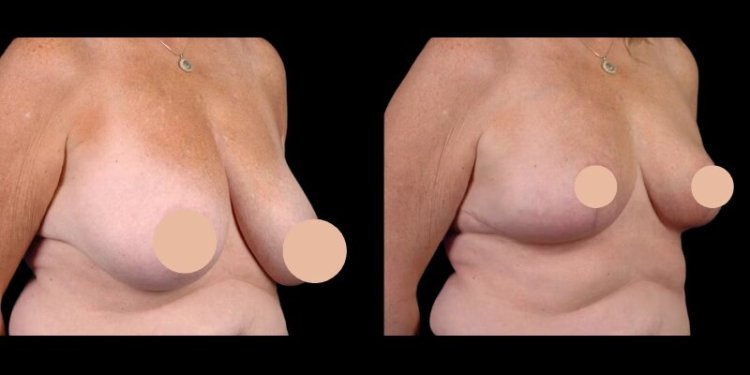 How Breast Reduction Surgery in dubai Enhances Comfort and Confidence