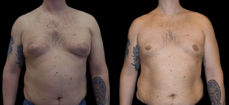 How to Maintain Your Chest After Gynecomastia Surgery in dubai