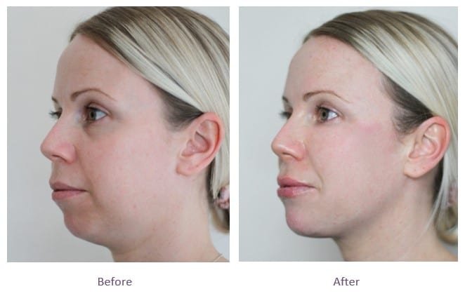 Enhance Your Jawline at the Best Aesthetic Clinics in dubai for Jawline Fillers