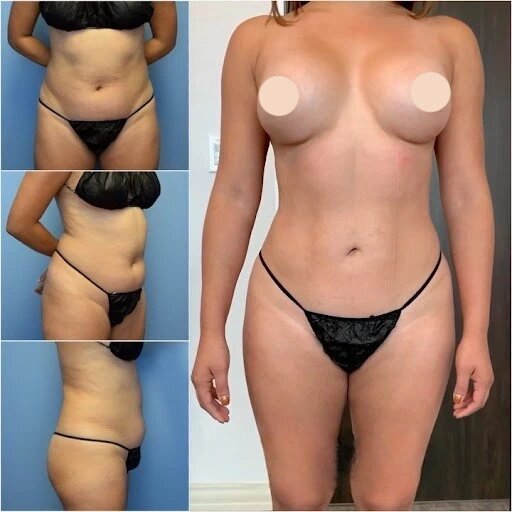 What to Expect During Body Contouring Procedures in Dubai