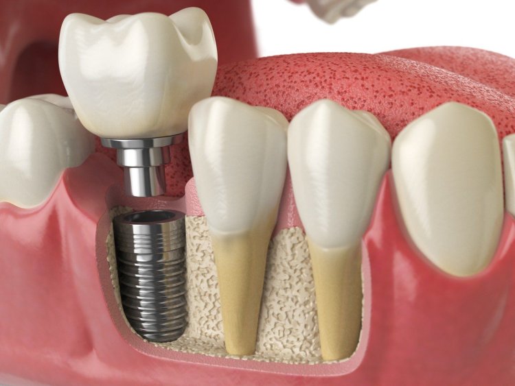 Clinicas dentales en Hospitalet de Llobregat: Tu Mejor Opción de Salud Bucal